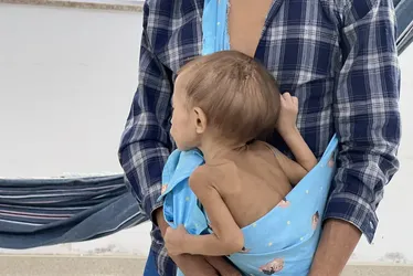 
			
				Com desnutrição grave, crianças yanomani tem peso de bebês
			
			