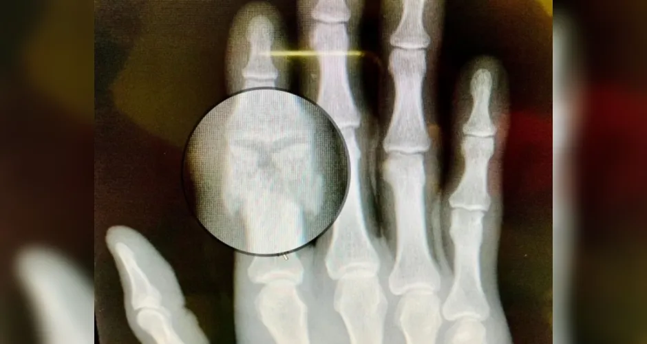 Imagem ilustrativa da imagem Goleiro Victor Souza, do CRB, sofre fratura em dedo e será operado 